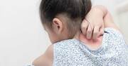【小児科医が教える】「肌が弱い子」に今すぐあげてほしい栄養ベスト2