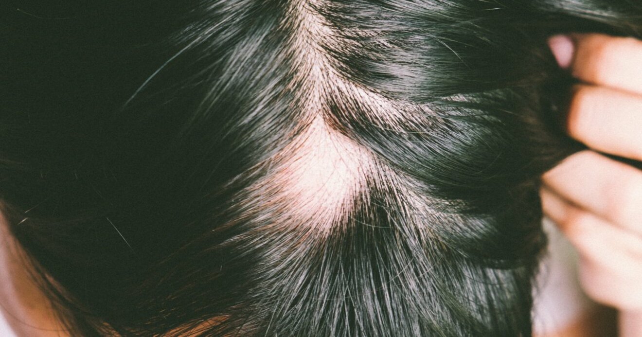 円形脱毛症の人が気をつけるべきカラダの不調とは 髪が増える術 ダイヤモンド オンライン