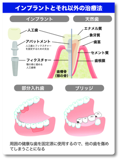 インプラント治療の流れを見てみよう