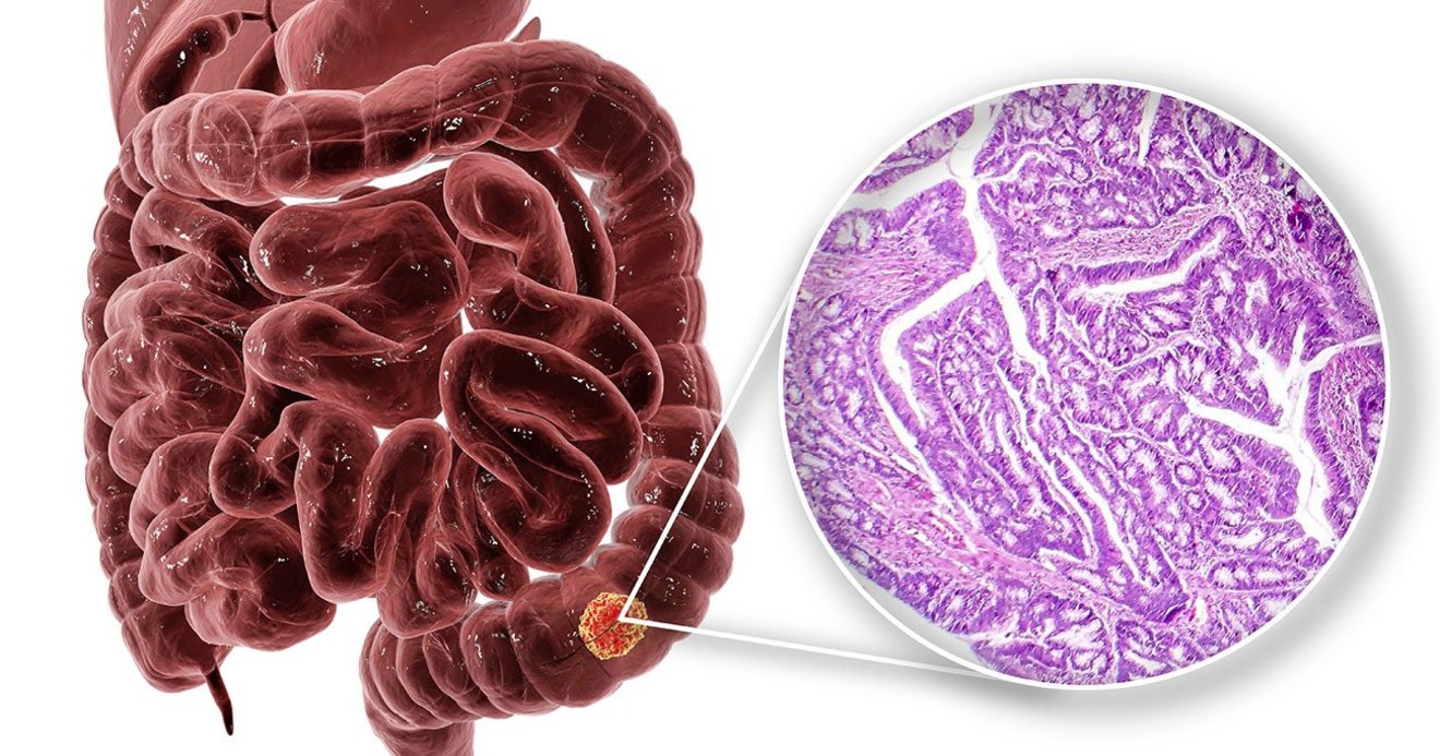 大腸がん発見に役立つ 血便以外の 意外なサイン とは 放っておくとこわい症状大全 ダイヤモンド オンライン