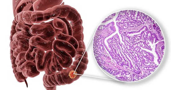 大腸がん発見に役立つ、血便以外の「意外なサイン」とは？