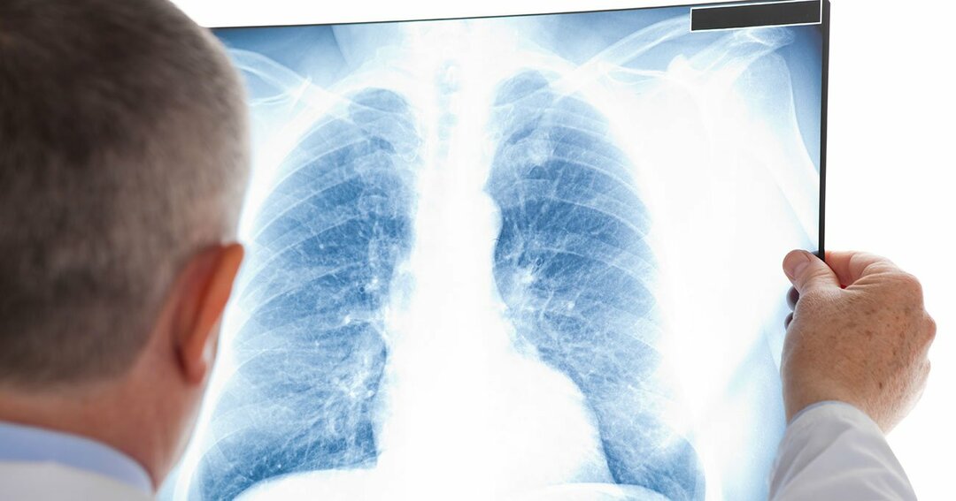 医者が「レントゲンバス」での肺がん検診を断る理由  放っておくと 
