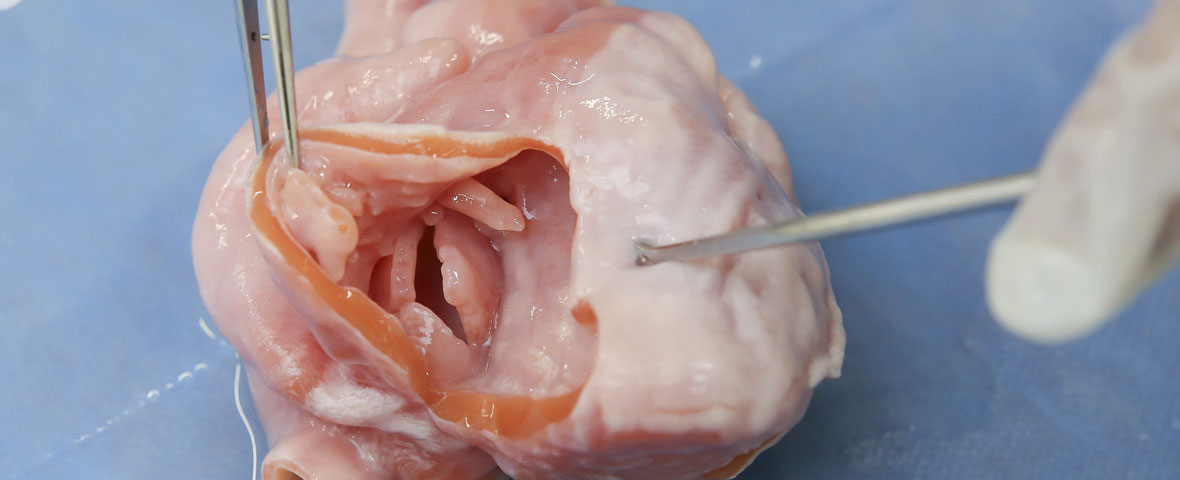 赤ちゃんの手術が「予習」できる超リアルな3D心臓モデル