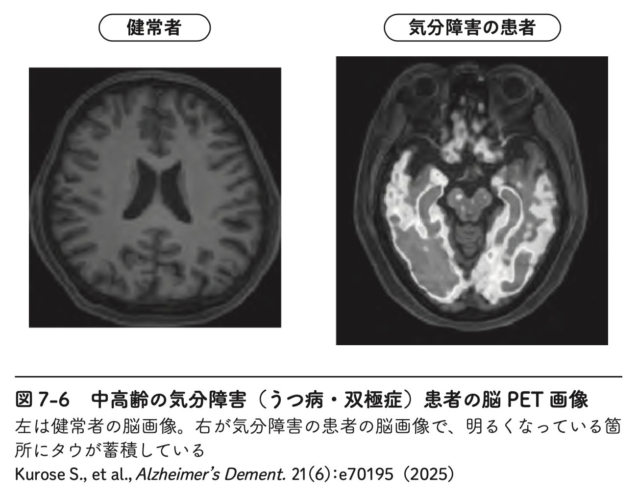図7-6 中高齢の気分障害（うつ病・双極症）患者の脳PET画像