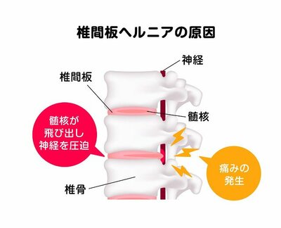 図：椎間板ヘルニアの原因
