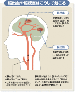 死亡率は減少も患者数は依然、多い「脳卒中」