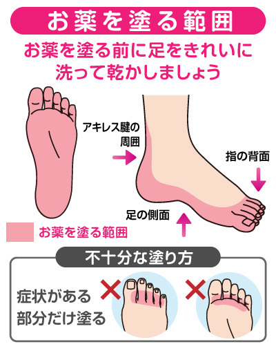 水虫治療最前線 南米産新種 かゆくない水虫も ニュース3面鏡 ダイヤモンド オンライン