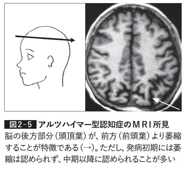 図表:アルツハイマー型認知症のMRI所見