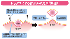 病変を局所的に切除する画期的な胃がん新手術