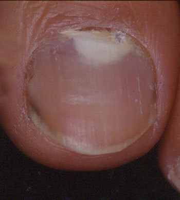 爪 白癬 菌 爪白癬・爪水虫の症例画像・症状・治療法 [皮膚・爪・髪の病気]