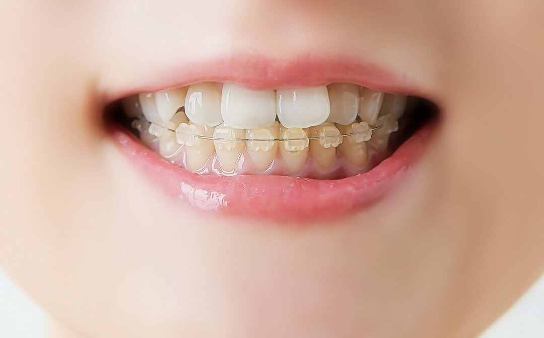 歯列矯正はワイヤーが外れれば終わり、というものではありません。