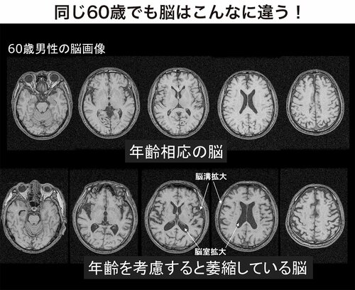 脳萎縮の様子