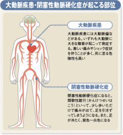 大動脈瘤の破裂はショック死に至る！大動脈疾患