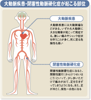 大動脈疾患・閉塞性動脈硬化症が起こる部位