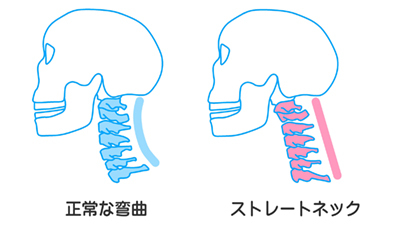 現代病「スマホ首」を予防する簡単ストレッチ