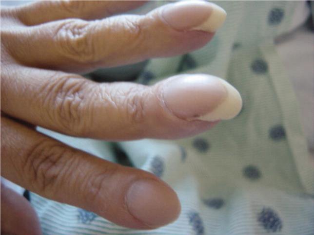 「爪」と「顔」を見れば一発でわかる…肝硬変、腎臓病、肺がん、貧血になりやすい人の「見た目」の特徴とは？【写真あり】〈2025会員ベスト9〉