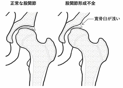 股関節形成不全