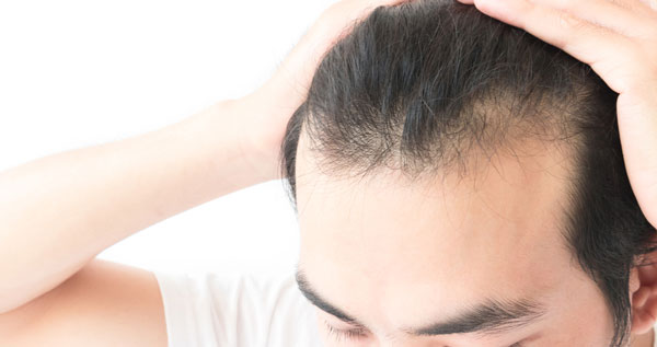夏の“抜けるリスク”こそ要注意若くても薄毛に直結!?　間違いだらけの「毛髪ケア」