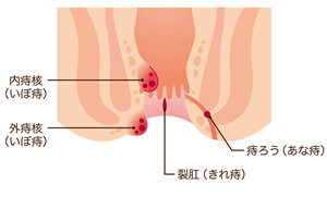 「痔主」3人に1人なのに半数が治療しない日本おしり事情