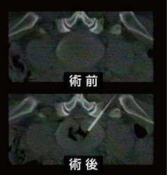 ひどい腰痛に、施術翌日にも仕事復帰可能な治療法切らずにレーザーで椎間板を焼くPLDD