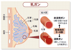 ガン種別最新動向（2）乳ガン