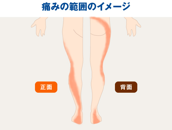 仕事のパフォーマンスにも悪影響の可能性?メカニズムが明らかになってきた「神経障害性疼痛」を知ろう