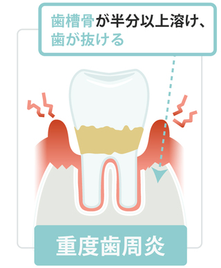 重度歯周病