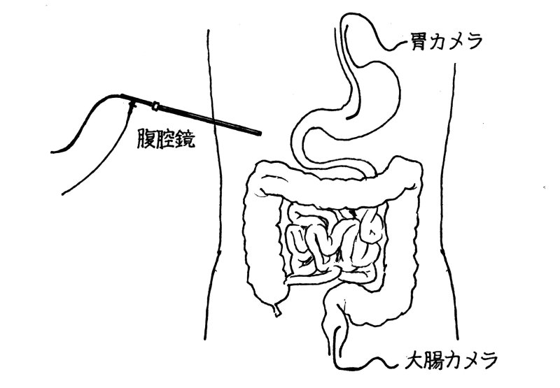 【外科医が教える】「内視鏡手術」のよくある誤解 胃カメラ、大腸カメラ、腹腔鏡はそれぞれどこを見ているのか?
