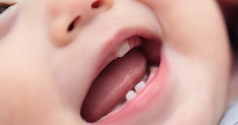 銀歯の8割は虫歯になる？保険診療で気を付けるべきポイントとは【歯科医が解説】