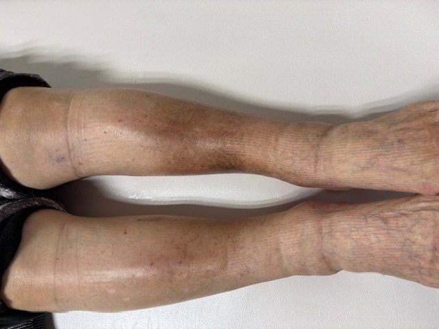 むくんでいる状態の足