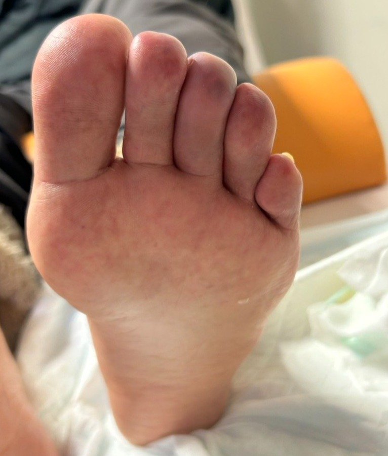 動脈硬化（虚血）