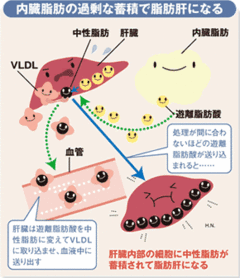 3000万人の国民病　非飲酒者でも肝硬変に脂肪肝