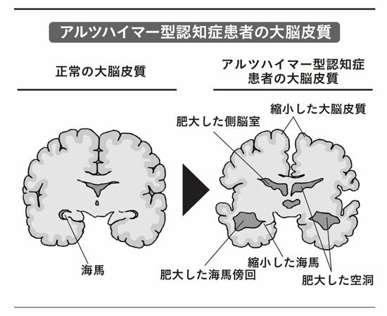 【91歳の医師が教える】人の名前がぜんぜん出てこない…もの忘れ、認知症を予防するカンタンにして毎日できること