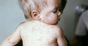 天然痘の生ワクチンに続いて次々と開発されてきたワクチンの種類とは？