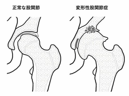 変形性股関節症