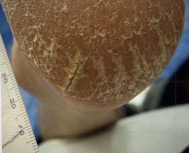 踵がカサカサしている（1）