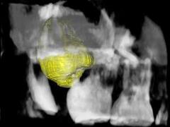 古代エジプトでも行われた歯の移植自分の親知らずをリサイクルする自家歯牙移植に注目