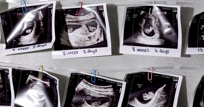 中絶反対派の団体が提供した超音波写真