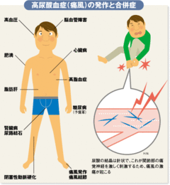 肥満男性を襲う激痛病動脈硬化促進の危険も 『痛風』