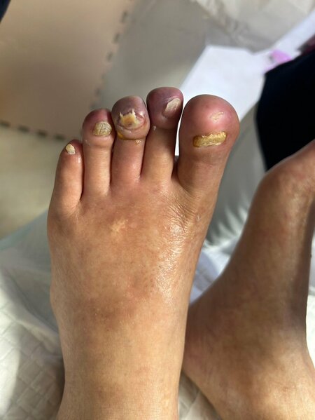 動脈硬化（虚血）