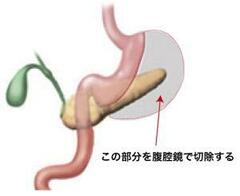 ＢＭＩ35以上の超肥満なら減量手術も選択肢