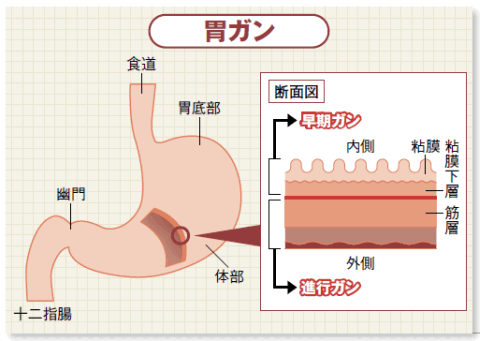 ガン種別最新動向(1)<br />胃ガン/肺ガン