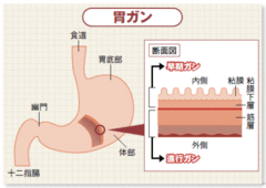 ガン種別最新動向（1）胃ガン／肺ガン