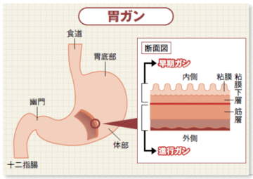 ガン種別最新動向(1)胃ガン/肺ガン