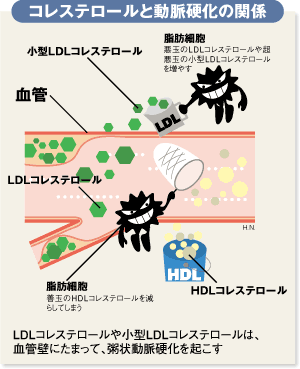 心臓病、脳卒中の主因「動脈硬化」1年間約30万人が死亡！