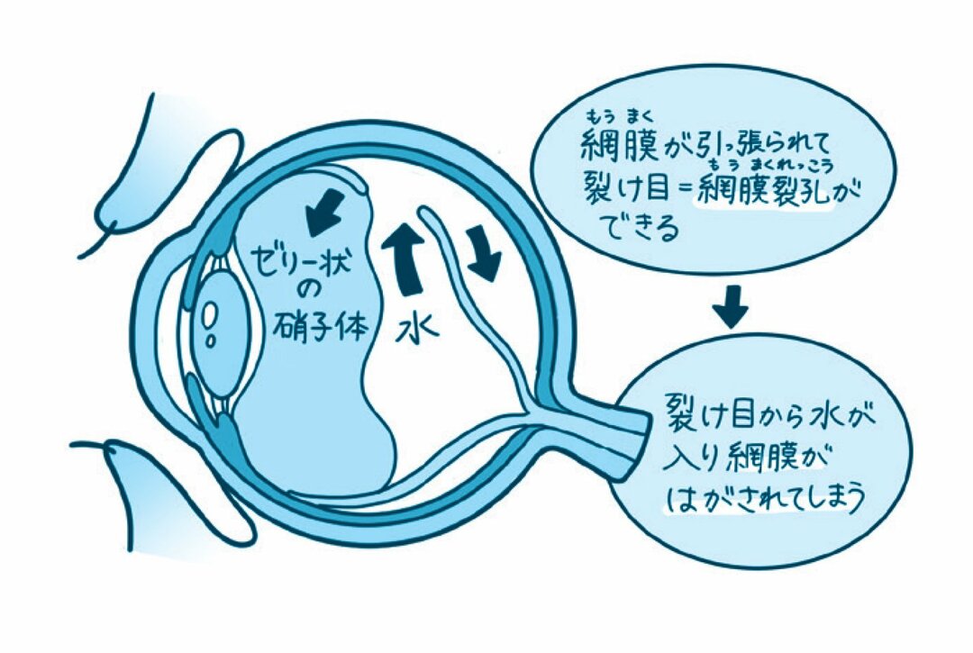 【『羽鳥慎一モーニングショー』で話題！ ハーバード×スタンフォードの名医が教える】<br />自覚症状がないまま<br />いつの間にか悪化している…<br />放っておくと怖い“目のトラブル”