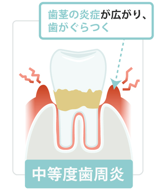 中度歯周病