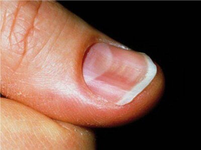 「爪」と「顔」を見れば一発でわかる…肝硬変、腎臓病、肺がん、貧血になりやすい人の「見た目」の特徴とは?【写真あり】