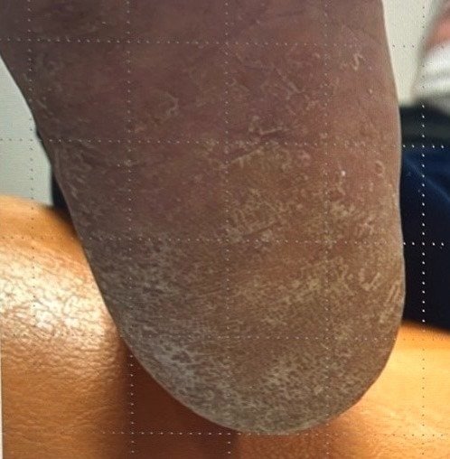 踵がカサカサしている（2）