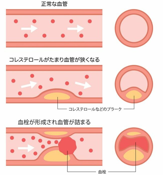 図表：動脈硬化のしくみ
